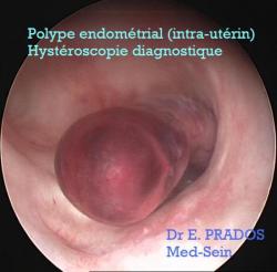 Polype endométrial à l'hysteroscopie diagnostique. Dr E. PRADOS/  Med-Sein