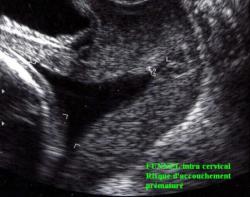ouvert du col de l'utérus : funnel interne. MAP. Dr E. PRADSOS  AFMGOS/ Med-Sein