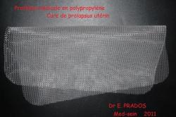 Prothèse médicale en polypropylène; Dr E. PRADOS - Med-Sein  / AFMGOS 2011