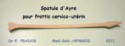 Spatule pour frottis cervical / Med-Sein /AMFGOS - Dr E. PRADOS 2011